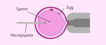 Oocyte Injection